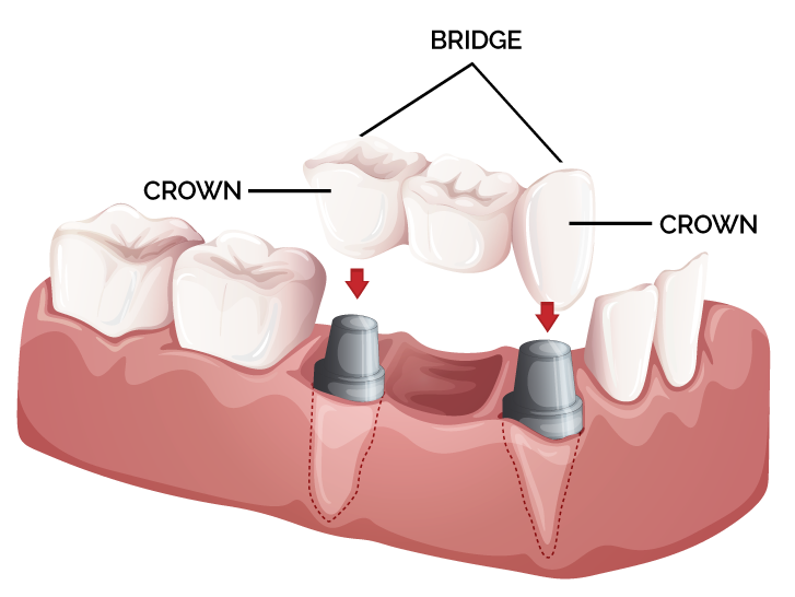 Crowns and bridges